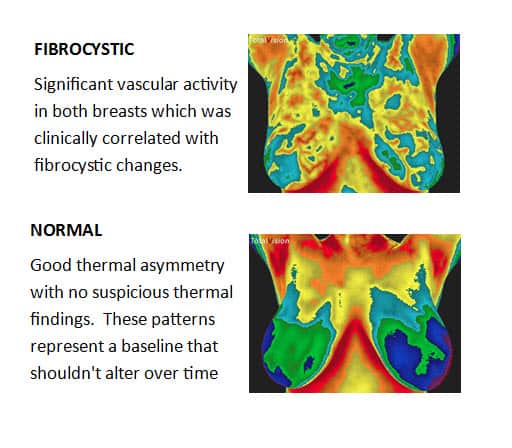 Br Health Screening - Fibrocystic